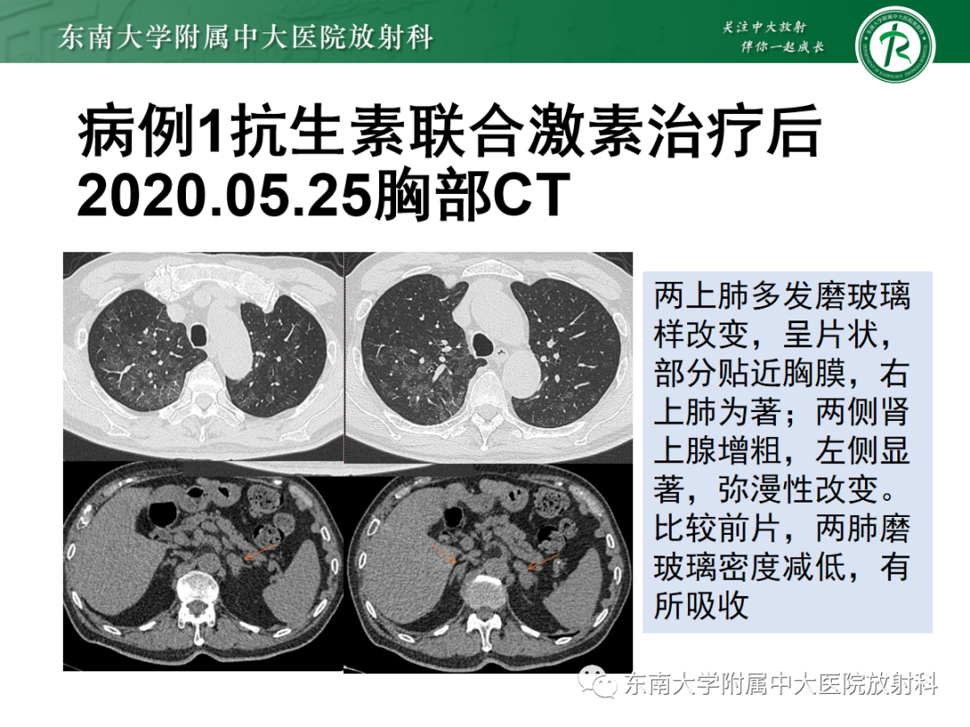 影像PPT - 【PPT】血管内大B细胞淋巴瘤-8 影像PPT - 【PPT】血管内大B细胞淋巴瘤-8