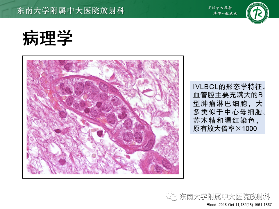影像PPT - 【PPT】血管内大B细胞淋巴瘤-18 影像PPT - 【PPT】血管内大B细胞淋巴瘤-18
