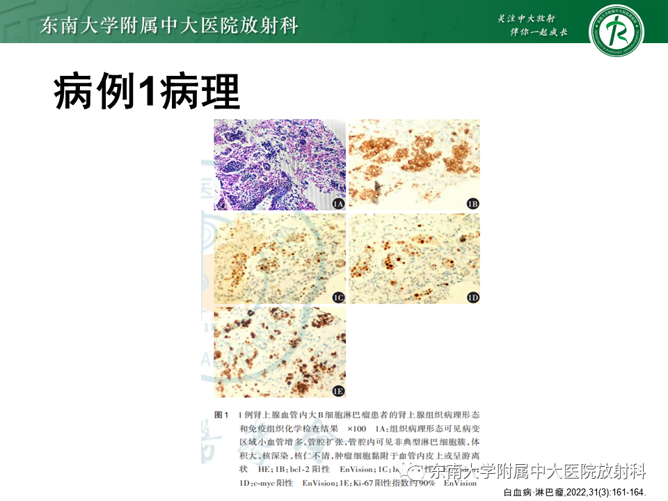 影像PPT - 【PPT】血管内大B细胞淋巴瘤-20 影像PPT - 【PPT】血管内大B细胞淋巴瘤-20