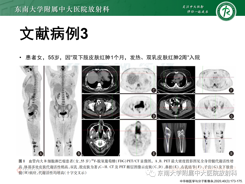影像PPT - 【PPT】血管内大B细胞淋巴瘤-35 影像PPT - 【PPT】血管内大B细胞淋巴瘤-35