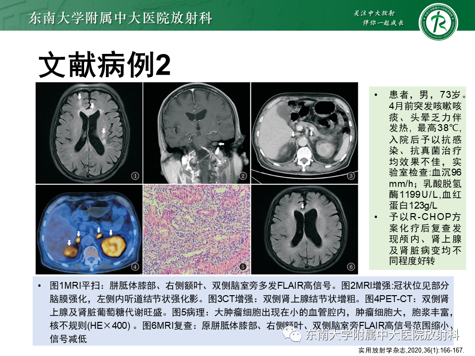 影像PPT - 【PPT】血管内大B细胞淋巴瘤-34 影像PPT - 【PPT】血管内大B细胞淋巴瘤-34