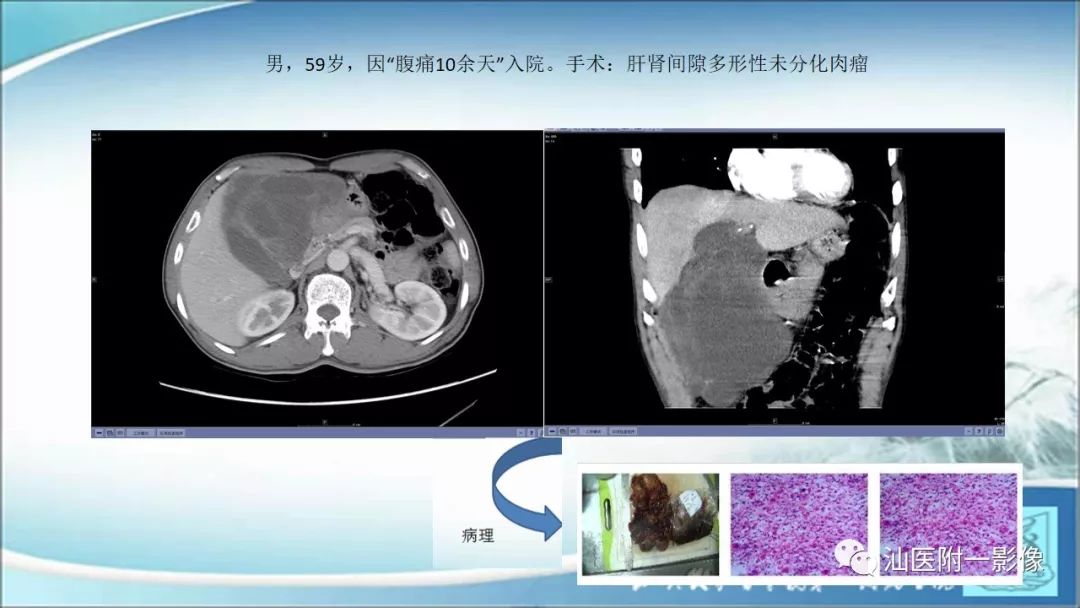 影像PPT - 【PPT】上腹囊性病变影像学分析-8