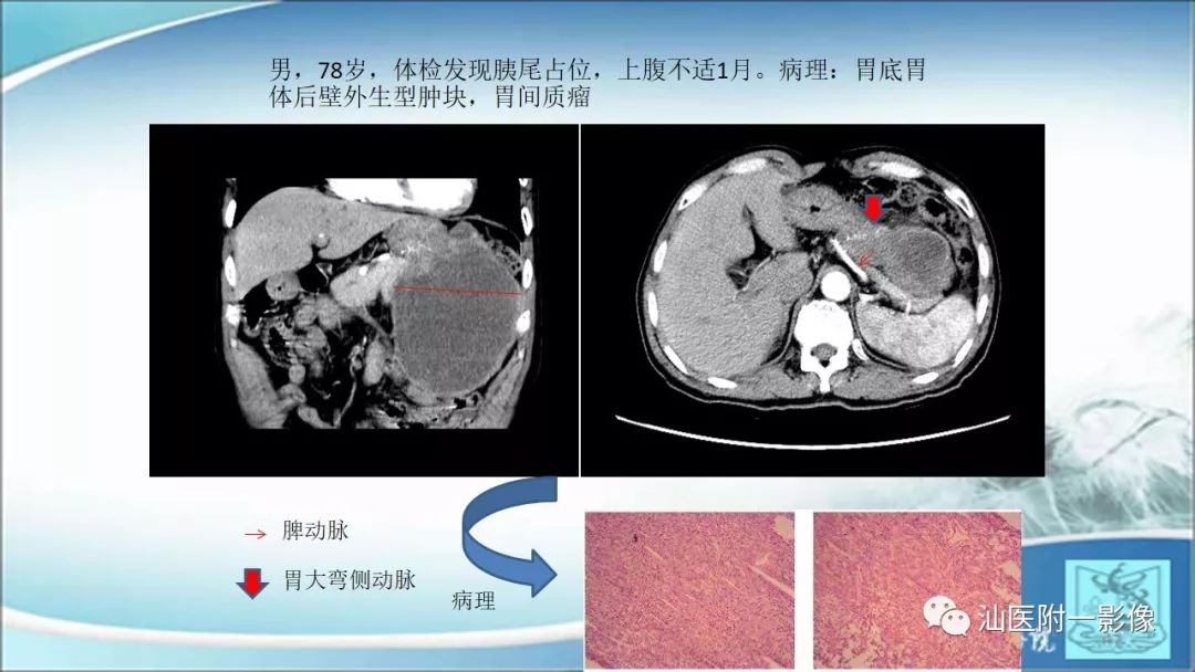 影像PPT - 【PPT】上腹囊性病变影像学分析-6