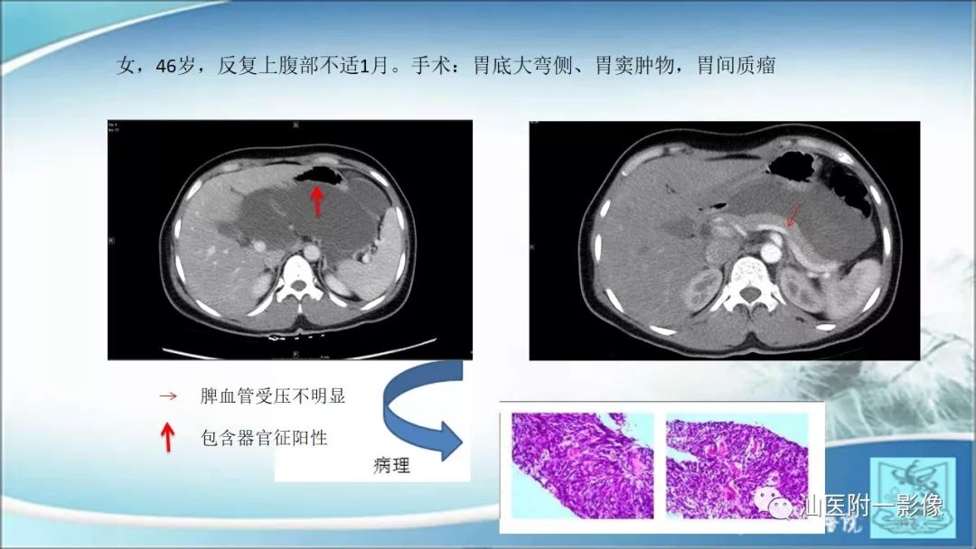 影像PPT - 【PPT】上腹囊性病变影像学分析-7