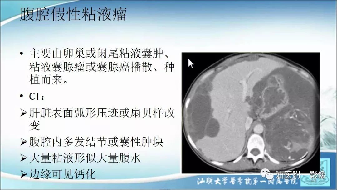 影像PPT - 【PPT】上腹囊性病变影像学分析-10