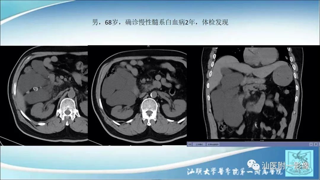 影像PPT - 【PPT】上腹囊性病变影像学分析-14