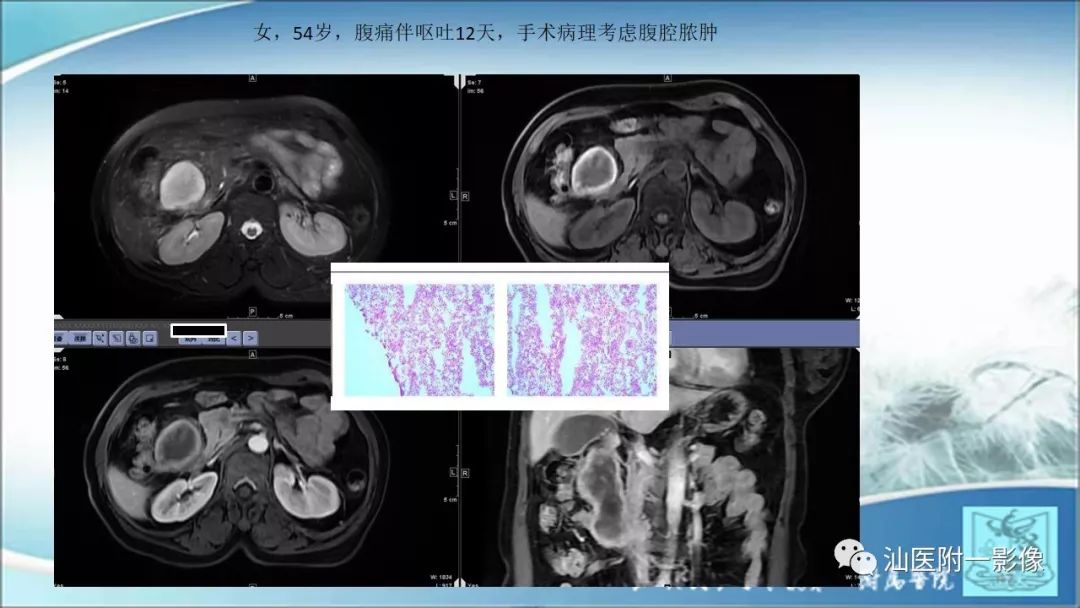 影像PPT - 【PPT】上腹囊性病变影像学分析-19