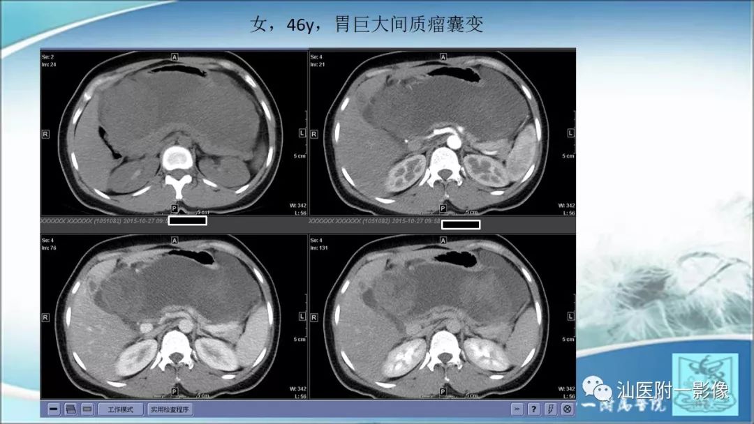 影像PPT - 【PPT】上腹囊性病变影像学分析-17