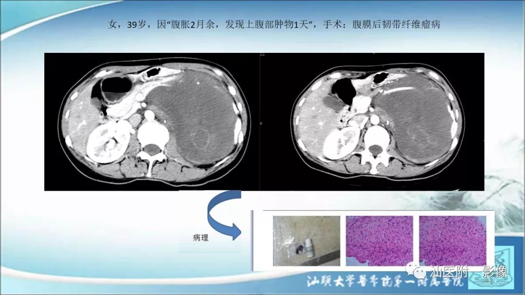 影像PPT - 【PPT】上腹囊性病变影像学分析-24