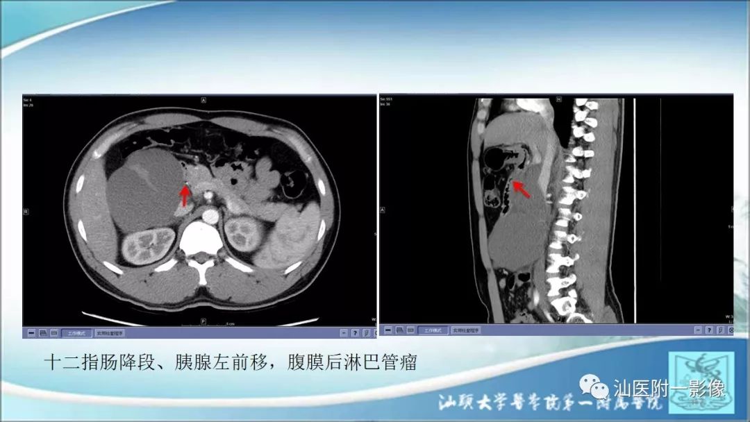 影像PPT - 【PPT】上腹囊性病变影像学分析-23