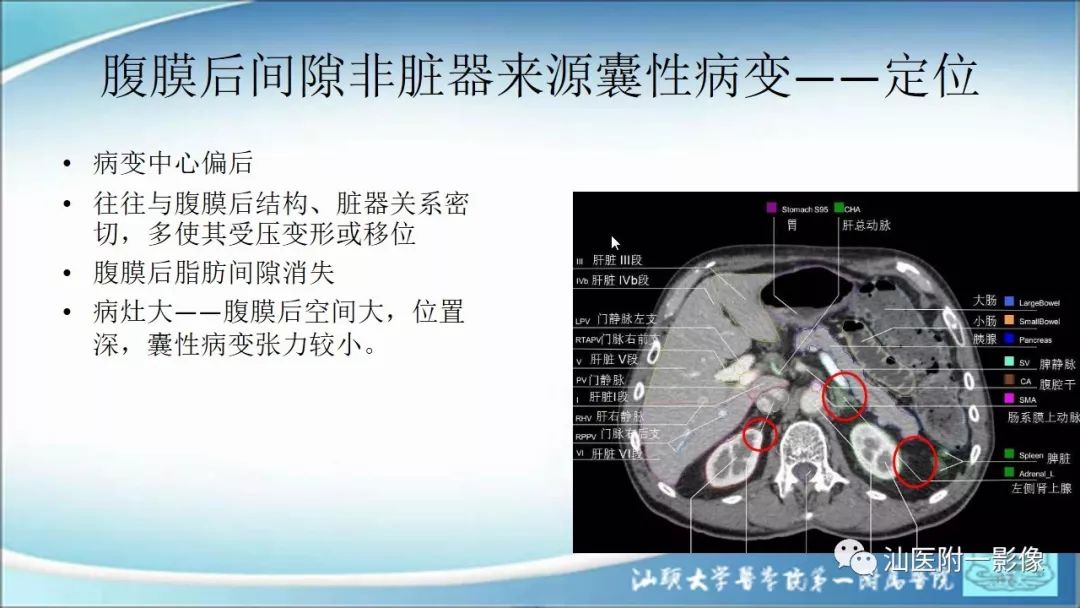 影像PPT - 【PPT】上腹囊性病变影像学分析-22