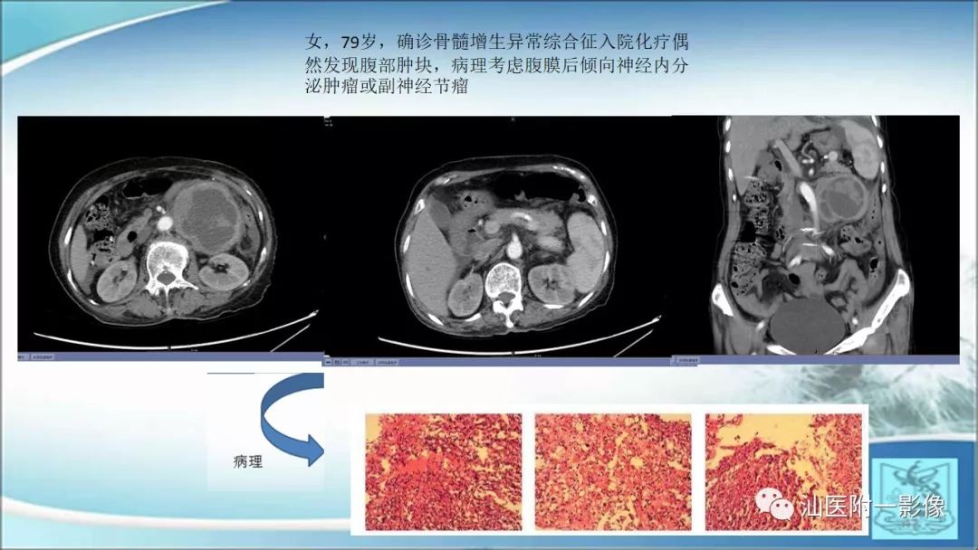 影像PPT - 【PPT】上腹囊性病变影像学分析-25