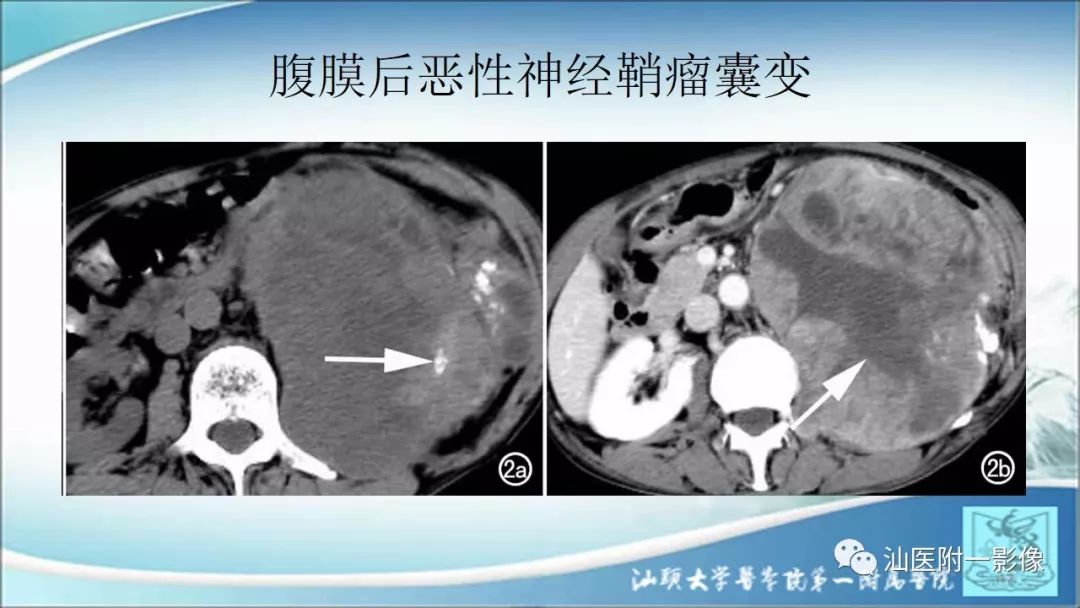 影像PPT - 【PPT】上腹囊性病变影像学分析-31