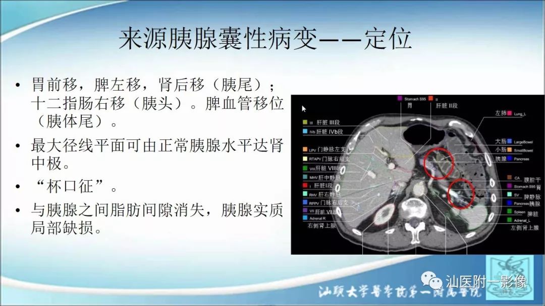 影像PPT - 【PPT】上腹囊性病变影像学分析-32