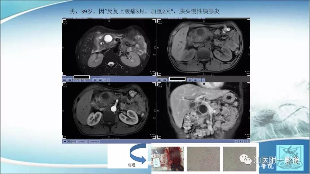 影像PPT - 【PPT】上腹囊性病变影像学分析-33