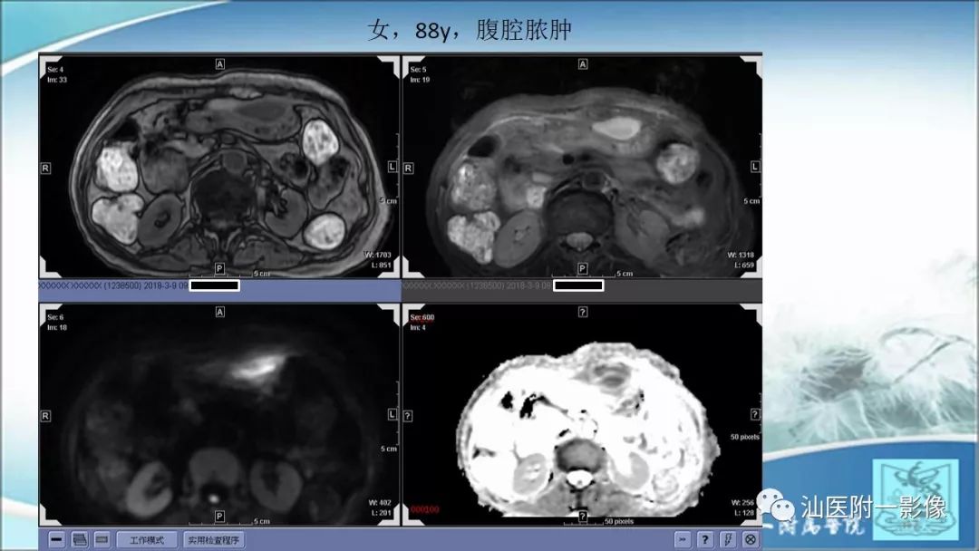影像PPT - 【PPT】上腹囊性病变影像学分析-20