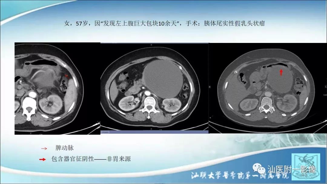 影像PPT - 【PPT】上腹囊性病变影像学分析-35