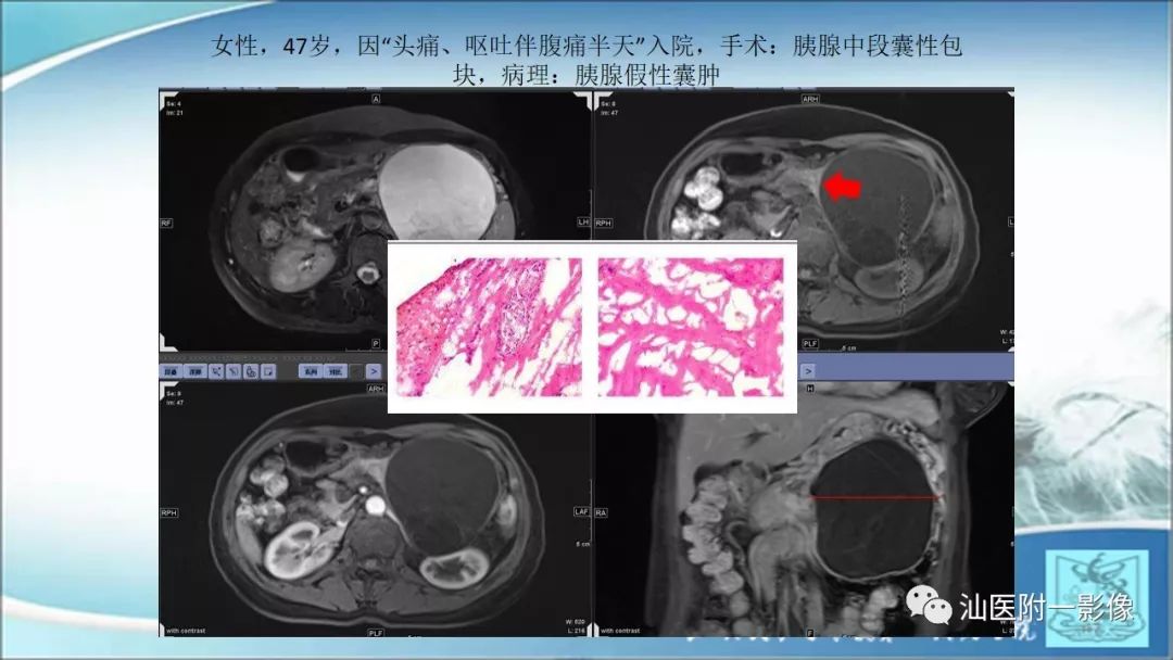 影像PPT - 【PPT】上腹囊性病变影像学分析-34