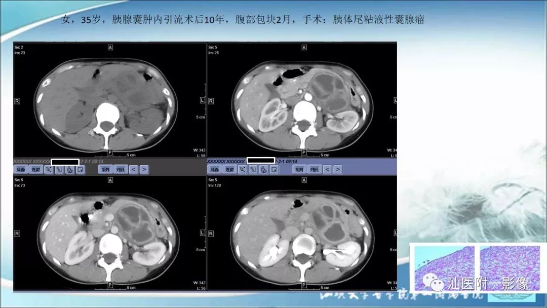 影像PPT - 【PPT】上腹囊性病变影像学分析-38