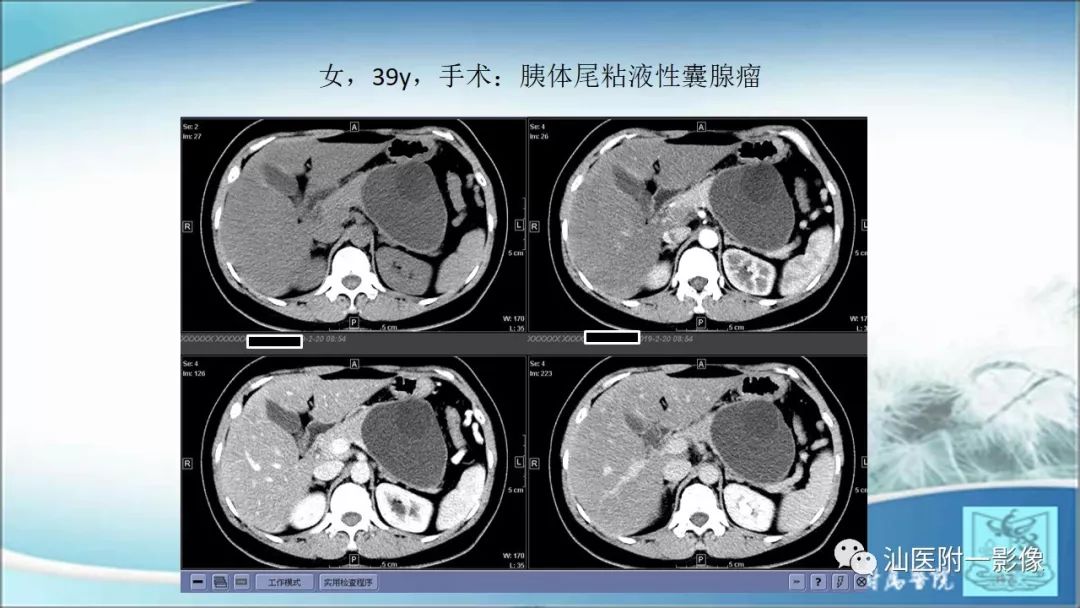 影像PPT - 【PPT】上腹囊性病变影像学分析-39