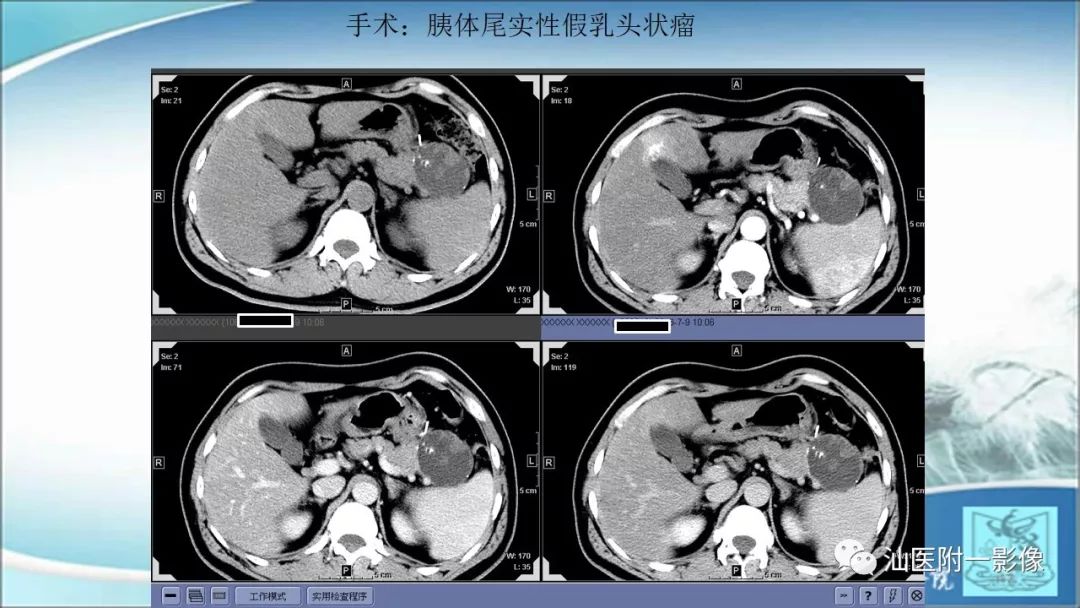 影像PPT - 【PPT】上腹囊性病变影像学分析-43