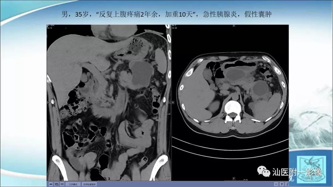 影像PPT - 【PPT】上腹囊性病变影像学分析-50