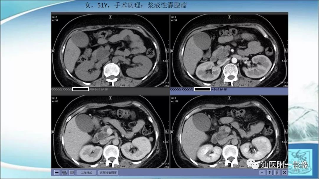 影像PPT - 【PPT】上腹囊性病变影像学分析-45