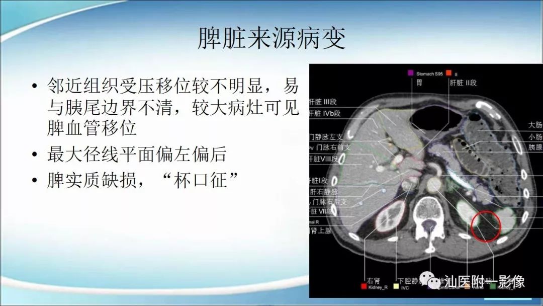 影像PPT - 【PPT】上腹囊性病变影像学分析-56
