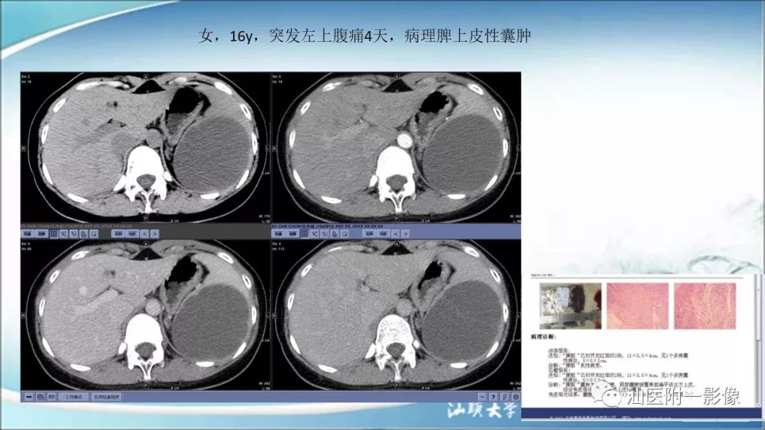 影像PPT - 【PPT】上腹囊性病变影像学分析-60