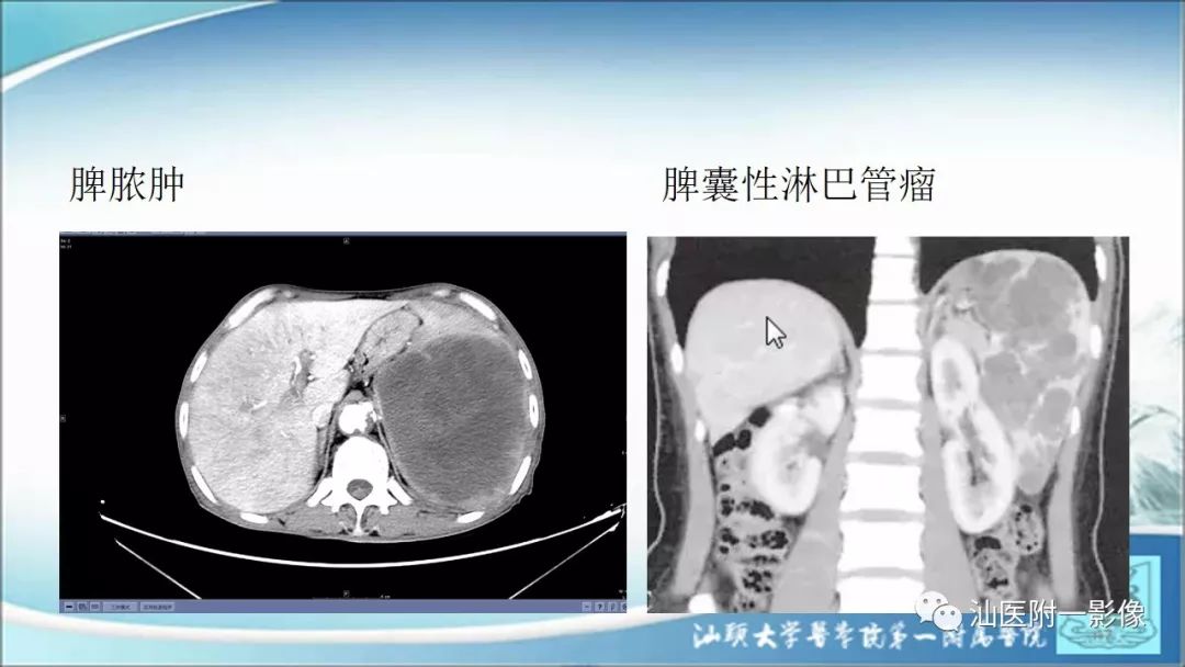 影像PPT - 【PPT】上腹囊性病变影像学分析-61
