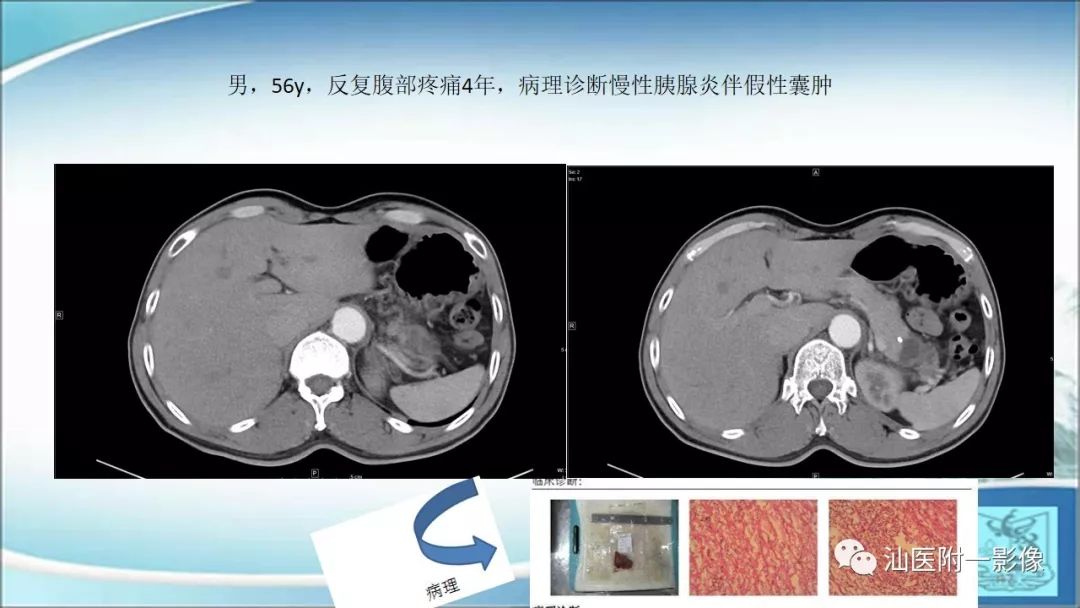 影像PPT - 【PPT】上腹囊性病变影像学分析-51