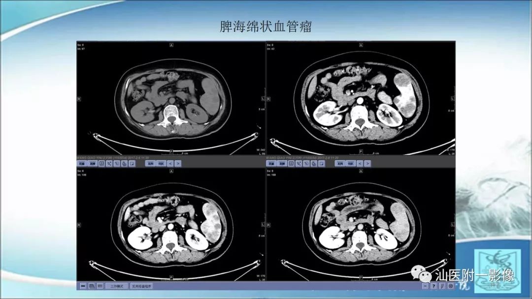 影像PPT - 【PPT】上腹囊性病变影像学分析-62