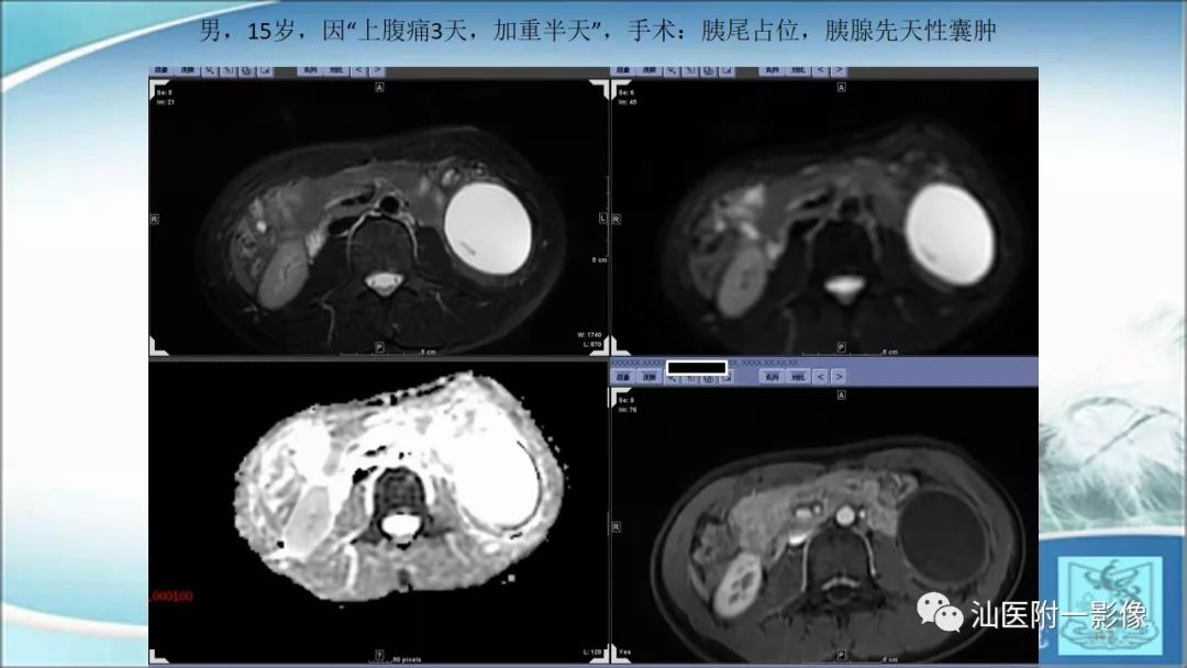 影像PPT - 【PPT】上腹囊性病变影像学分析-53