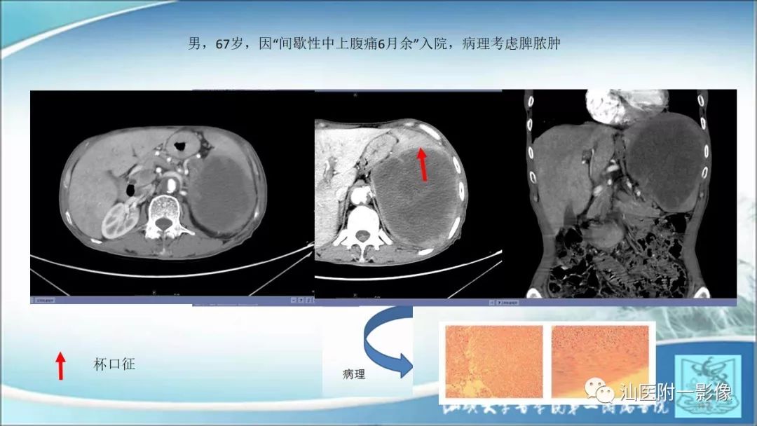 影像PPT - 【PPT】上腹囊性病变影像学分析-57