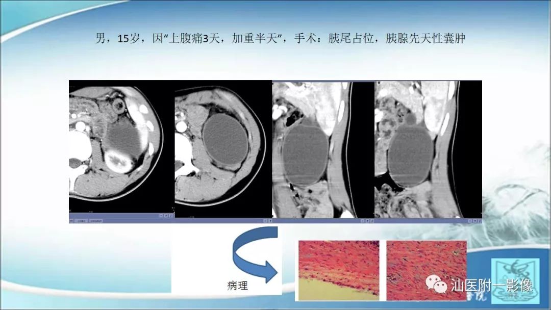 影像PPT - 【PPT】上腹囊性病变影像学分析-54