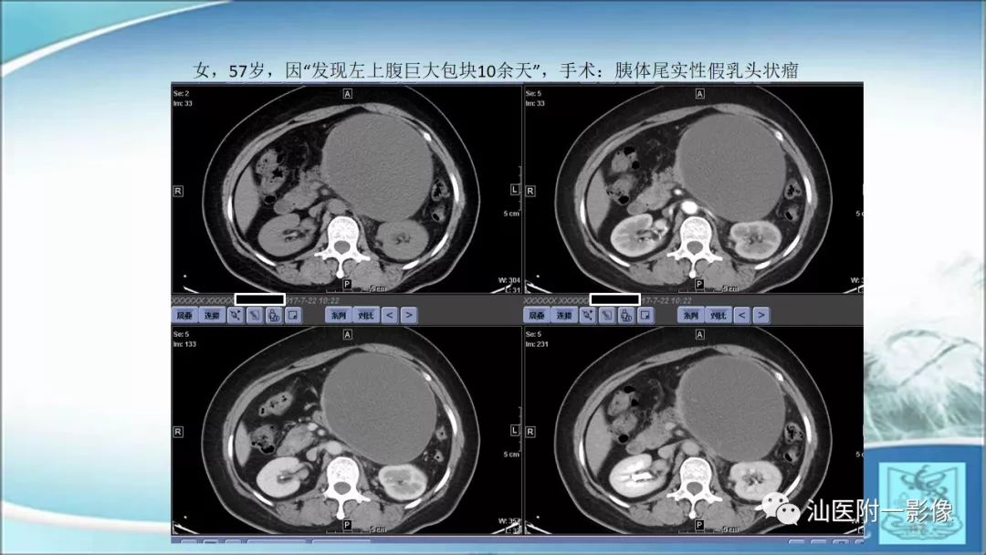 影像PPT - 【PPT】上腹囊性病变影像学分析-41