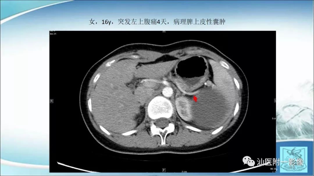 影像PPT - 【PPT】上腹囊性病变影像学分析-58