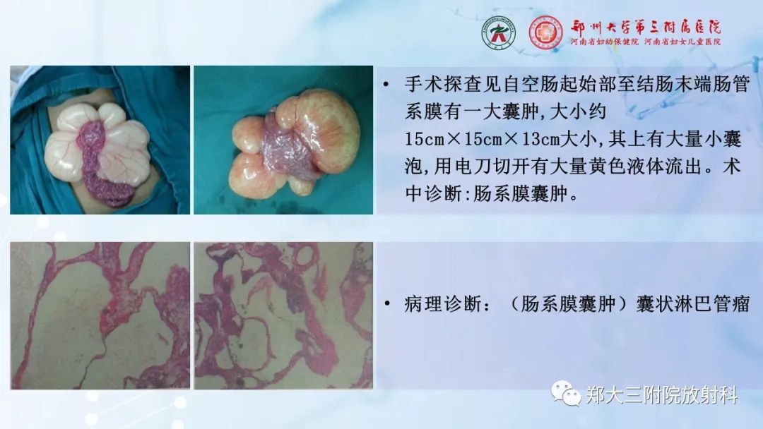 影像PPT - 【PPT】儿童腹部囊性病变诊断思路分析-5