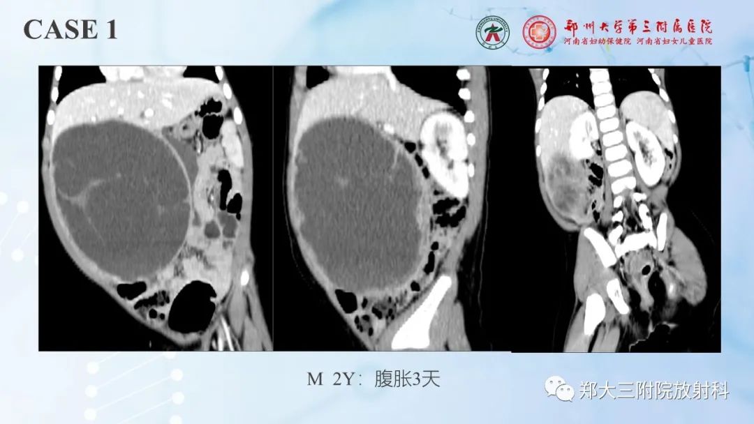 影像PPT - 【PPT】儿童腹部囊性病变诊断思路分析-7
