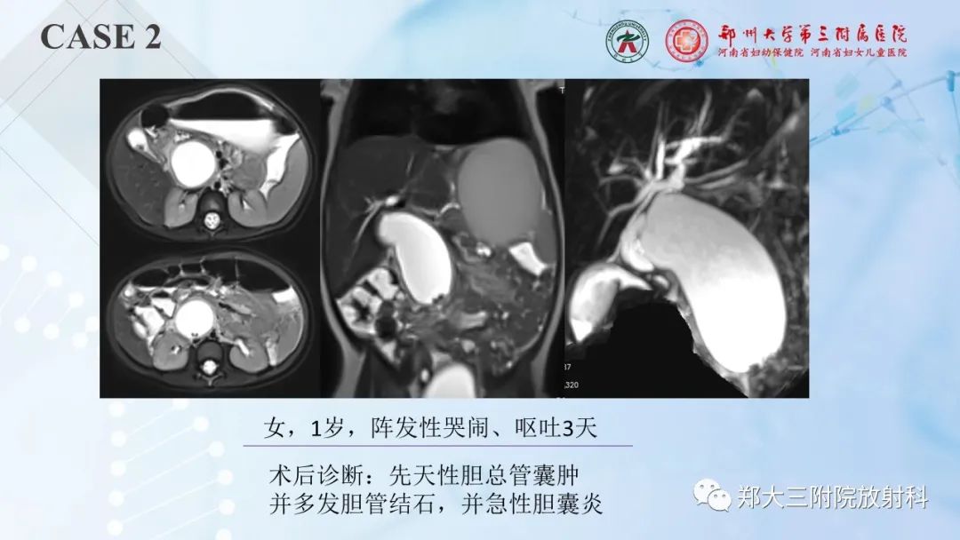 影像PPT - 【PPT】儿童腹部囊性病变诊断思路分析-13