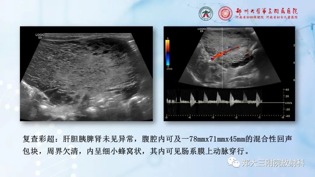 影像PPT - 【PPT】儿童腹部囊性病变诊断思路分析-3