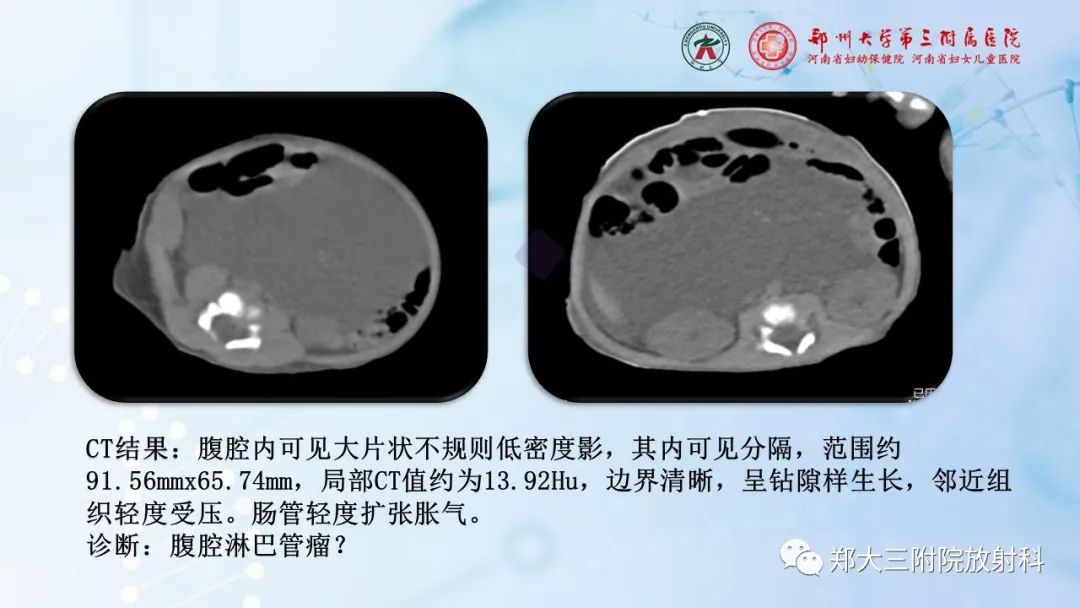 影像PPT - 【PPT】儿童腹部囊性病变诊断思路分析-4