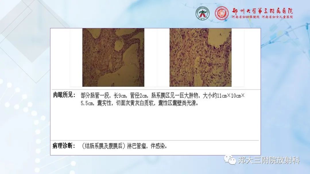 影像PPT - 【PPT】儿童腹部囊性病变诊断思路分析-22