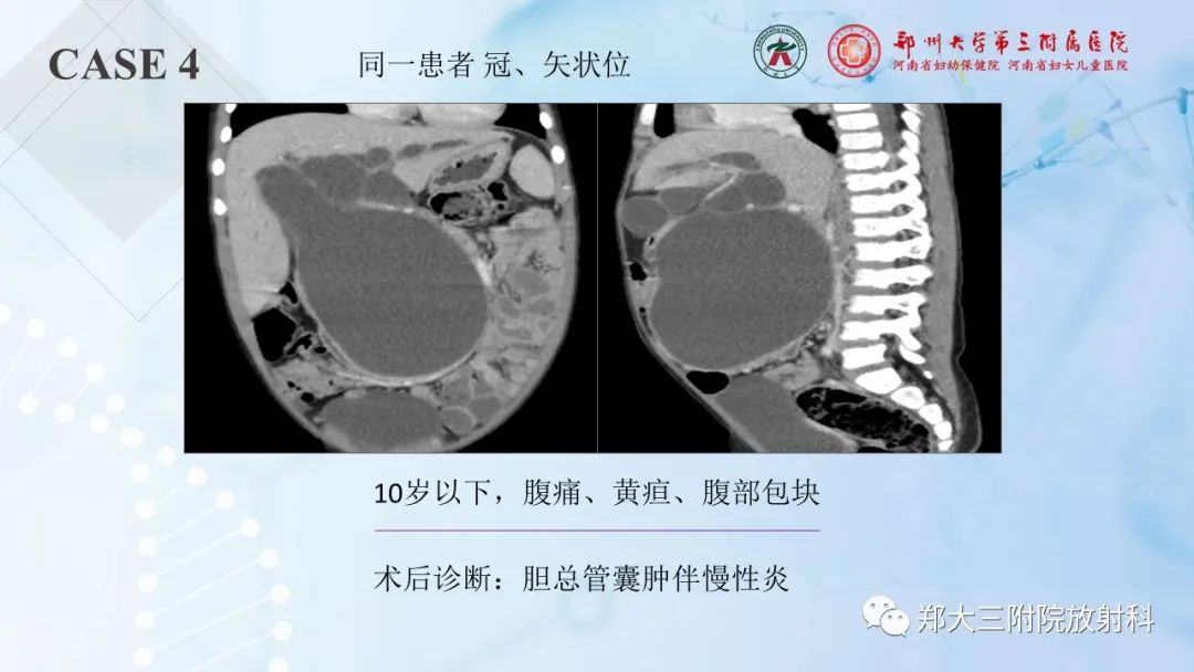 影像PPT - 【PPT】儿童腹部囊性病变诊断思路分析-15