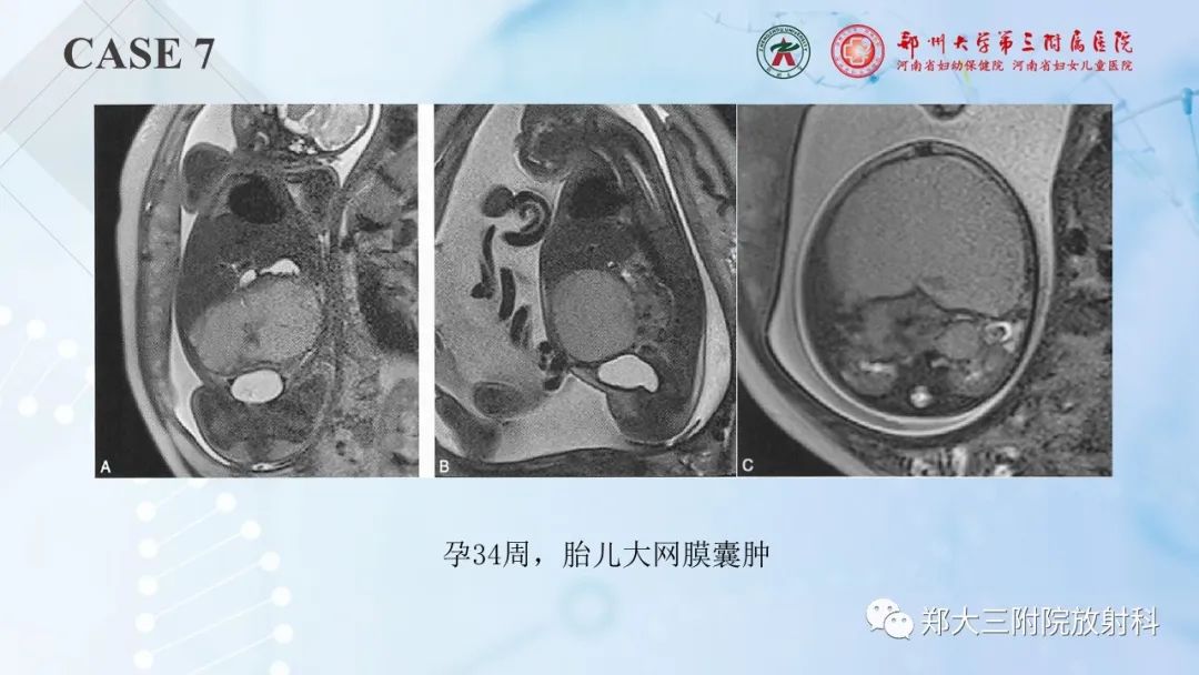 影像PPT - 【PPT】儿童腹部囊性病变诊断思路分析-26