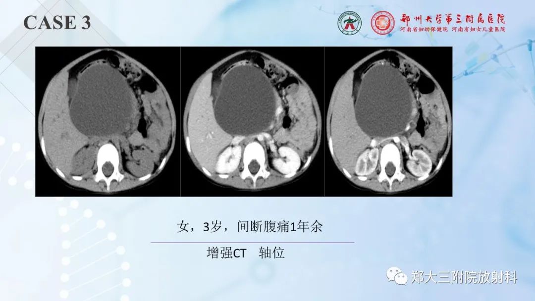 影像PPT - 【PPT】儿童腹部囊性病变诊断思路分析-14