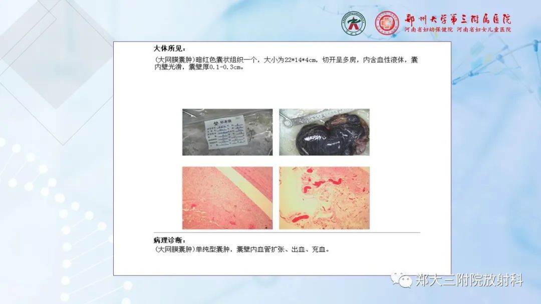 影像PPT - 【PPT】儿童腹部囊性病变诊断思路分析-28