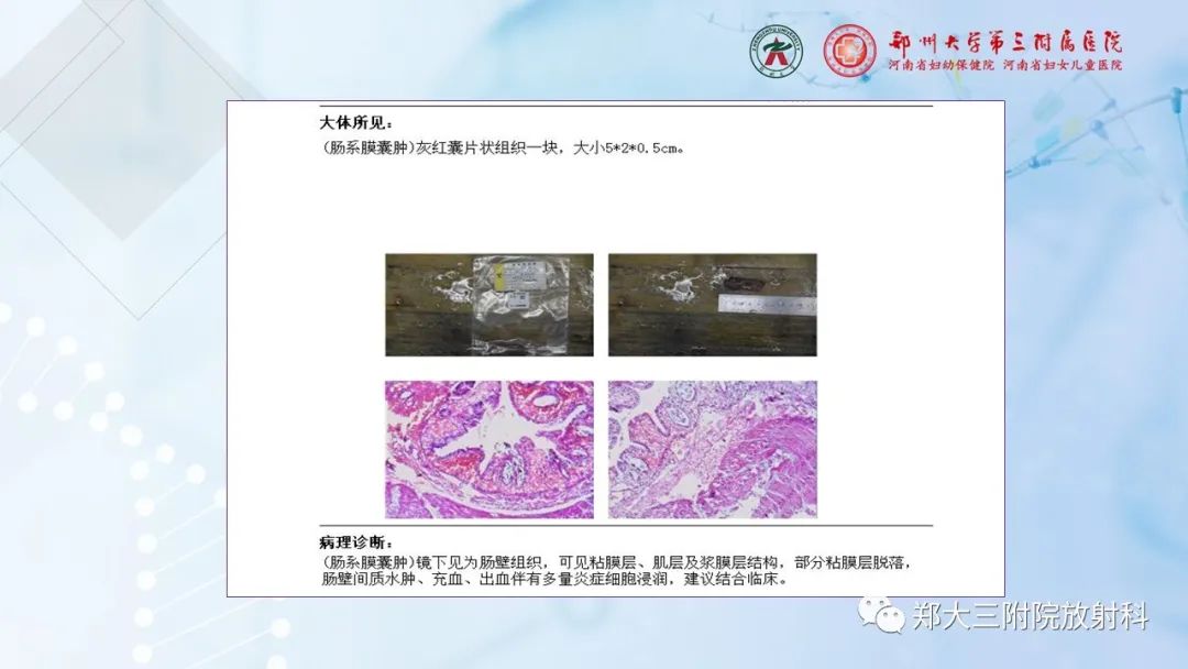 影像PPT - 【PPT】儿童腹部囊性病变诊断思路分析-31