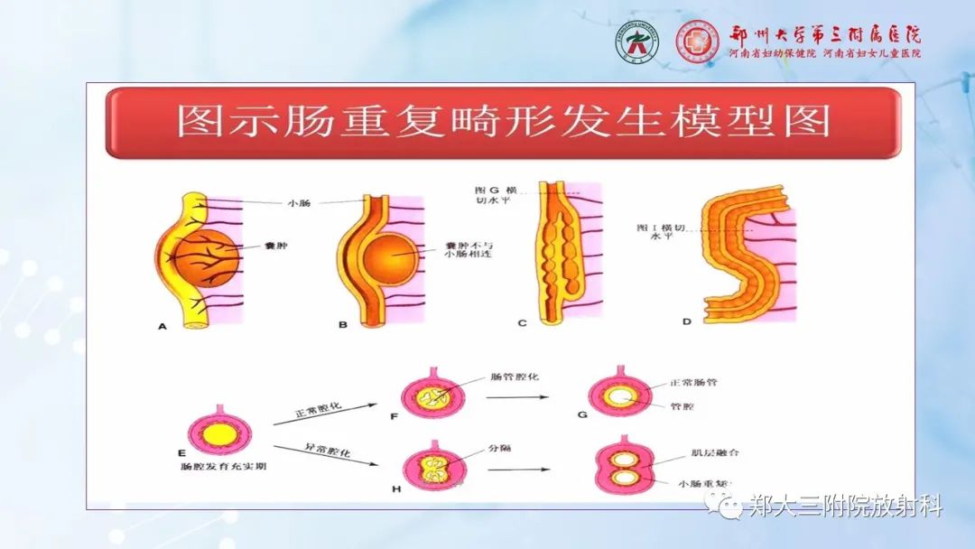 影像PPT - 【PPT】儿童腹部囊性病变诊断思路分析-33