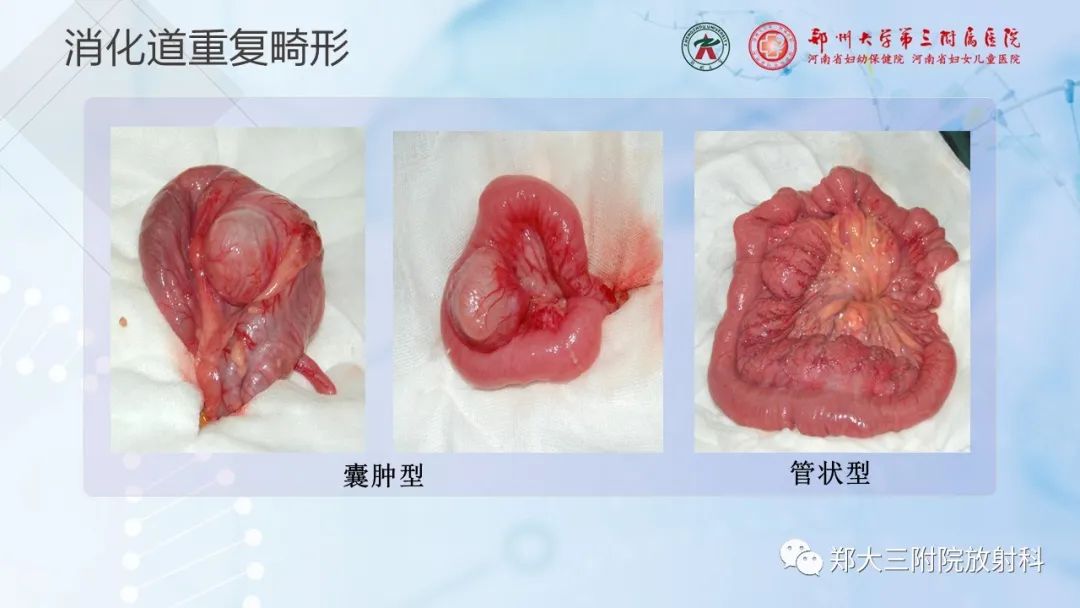 影像PPT - 【PPT】儿童腹部囊性病变诊断思路分析-37